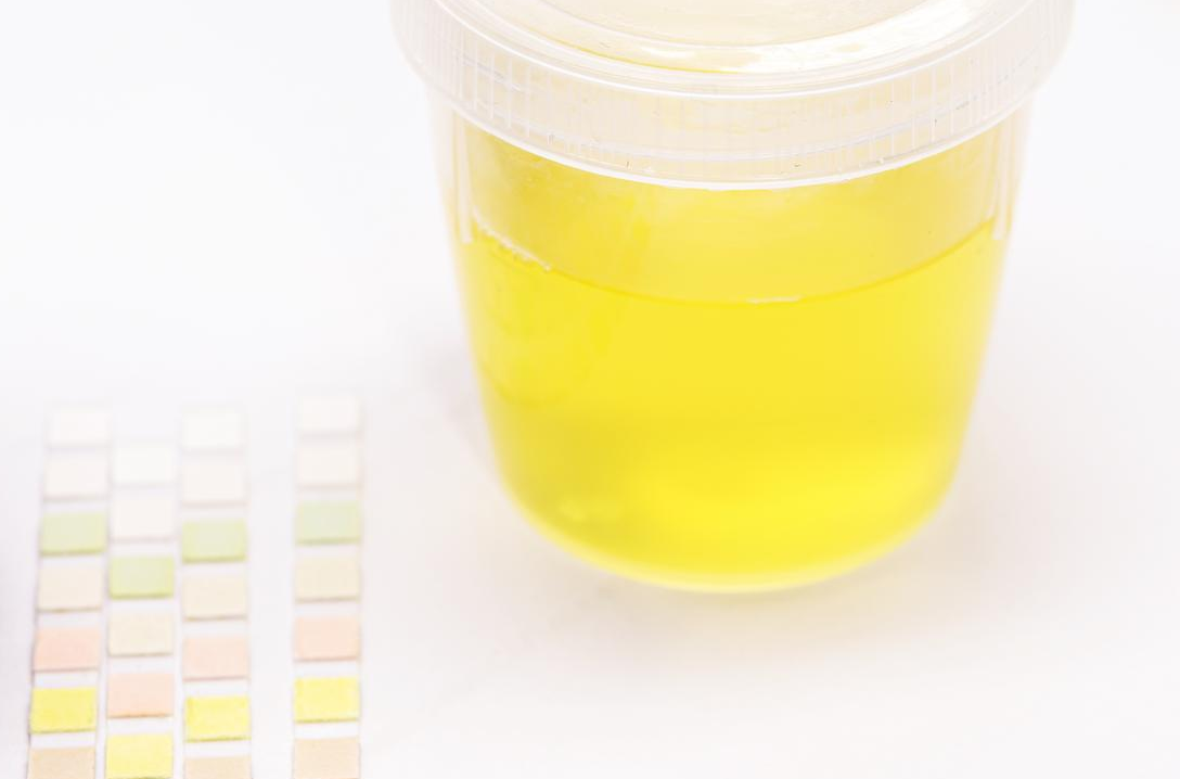 How Urinalysis Can Help with Liver Health